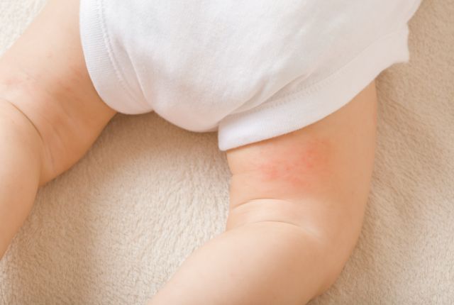 アレルギー性皮膚炎ができた赤ちゃんの脚